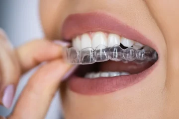 How To Care For Your Braces Or Clear Aligners