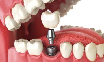 Dental Implantation for Missing Chewing Teeth: Why Timely Restoration Matters