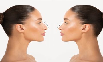Nose Reshaping Surgery: A Popular Solution for Aesthetic and Functional Concerns