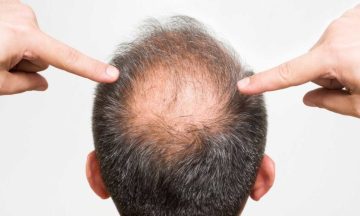 Understanding Hair Loss and Thinning: Why Products Plateau and What Comes Next
