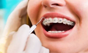 Teeth Straightening Singapore: Options for a Better Smile